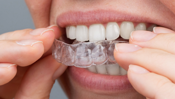 How Is Invisalign® For Teens Different Than Invisalign® For Adults?